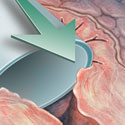 Medical illustration urethrotomy surgery thumbnail