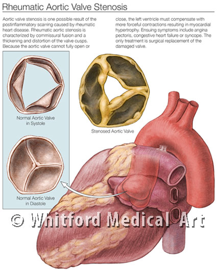 medical illustration rheumatic aortic valve stenosis patient education