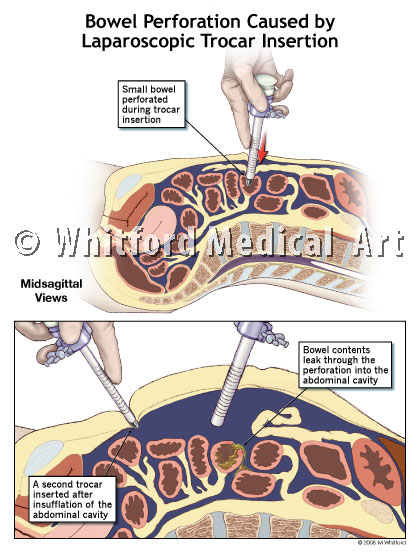 medical legal illustration of trocar insertion